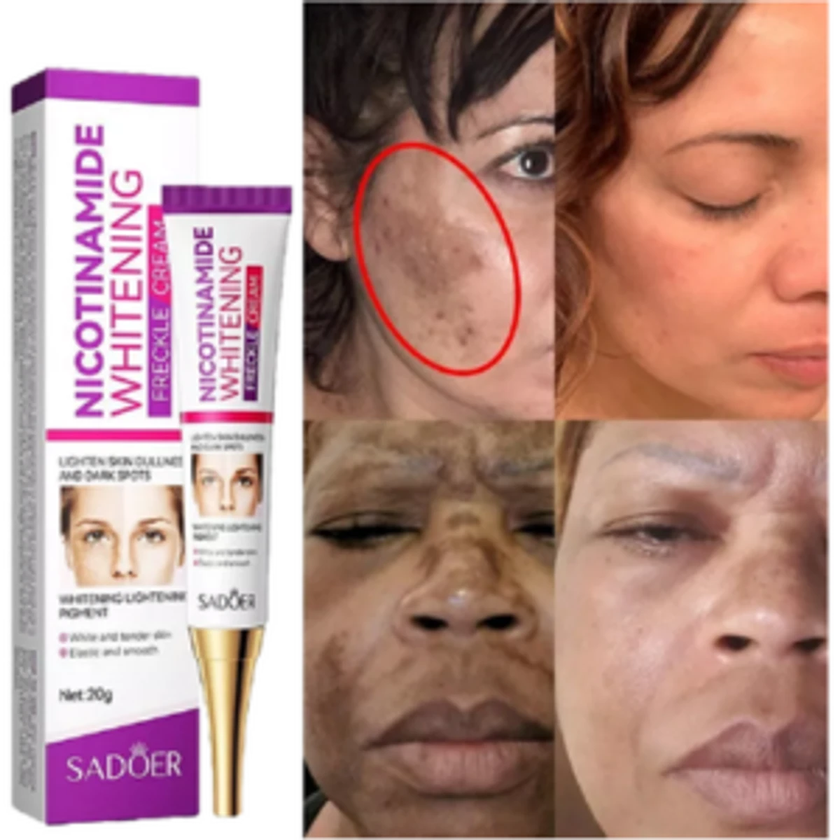 Freckle Removal Cream Moisturizing Moisturizing - Image 5